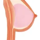Gelee Brüste